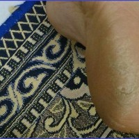 درمان ترک و خشکی پاشنه پا چیست؟