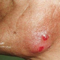 عکس اکتینومایکوز