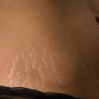 کربوکسی تراپی و PRP کدامیک در درمان استریا موثرتر است؟