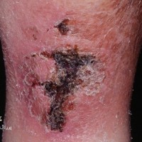عکس کلسیفیلاکسی Calciphylaxis