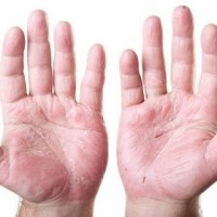 برای درمان حساسیت دستم چه کاری باید انجام دهم؟