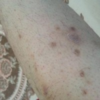 لک های ناشی از التهاب پوست چگونه درمان می شوند؟
