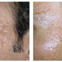 ساب سیژن چیست subcision ؟