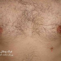 عکس نوک پستان اضافه