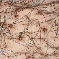 عکس شپش تناسلی (عانه)