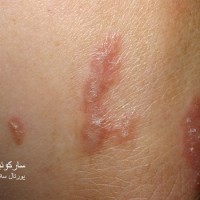 عکس سارکوئیدوز
