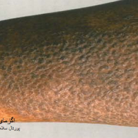 عکس اگزمای پینه بسته