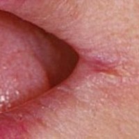 درباره ترک خوردگی گوشه لب (Angular cheilitis) بیشتر بدانیم 