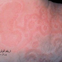 عکس بیماری اریتم آنولر سنتریفوگوم