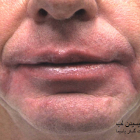 اگزما ناشی از لیسیدن لب