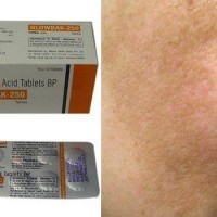 اثر بخشی ترانکسامیک اسید خوراکی در درمان ملاسمای متوسط تا شدید