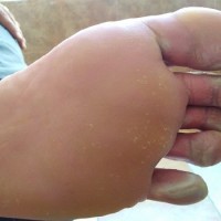 pitted keratolysis  عفونت باکتریایی کف پا 