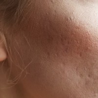 برای جای جوش چه لیزری پیشنهاد میکنید؟