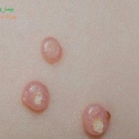 بیماری ویروسی مولوسکوم یا زگیل آبکی