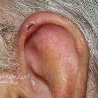 عکس کندرودرماتیت ندولر گوش