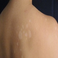 علت خارش  و ایجاد لکه های سفید رنگ بر روی کمر من چه میتواند باشد؟