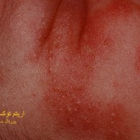 عکس اریتم توکسیک نوزادی