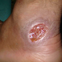 سالک   Leishmaniasis