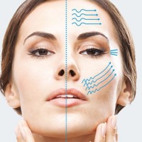 آیا اولتراپی با هایفو فرق دارد و کدامیک بهتر است؟ اولتراسل چیست؟