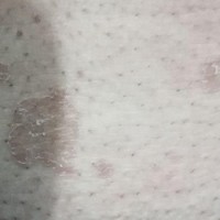 روش درمان ضایعات قارچ چند رنگی چیست؟