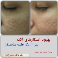 انواع روشهای درمانی اسکار آکنه