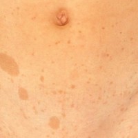 لکه های  شیر قهوه ای و راه درمان آن چیست؟