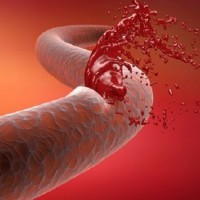 روش جدید قطع خونریزی داخلی با نانو