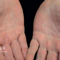 عکس قارچ کچلی دست