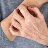 استفاده از داروهای ضد افسردگی خوراکی در خارش مزمن