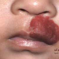   عکس همانژیوم لب