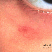 عکس آنژیوم عنکبوتی
