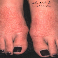 حساسیت به چرم کفش