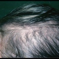 چربی  پوست سر به چه علتی ایجاد میشود؟