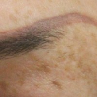 قرمزی محل لیزر خالکوبی ابروهایم چگونه درمان میشود؟