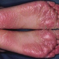 سندروم جوراب خیس