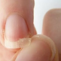 دلایل شکننده بودن ناخن چیست؟