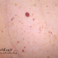 خال عروقی گیلاسی