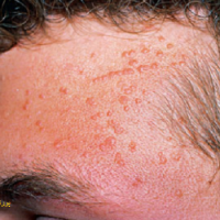 عکس زگیل مسطح