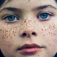 کک و مک چگونه ایجاد می شود؟ درمان آن با دارو است یا لیزر؟