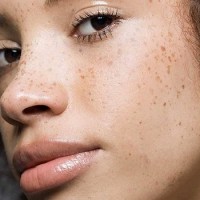 آیا کک و مک با لیزر درمان میشود؟