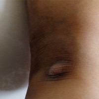 رفع تیرگی قوزک پا و زیر بغل