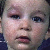 عکس سندروم  ولز