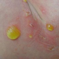 زردزخم (impetigo) و راههای درمان آن 