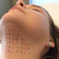 داروی تزریقی کیبلا درمان تایید شده غبغب