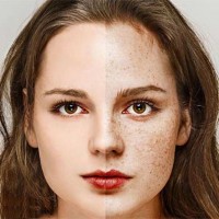 آیا لکه های قهوه ای پوست طبیعی هستند؟