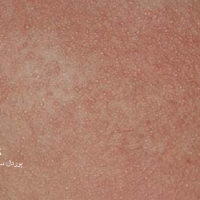 پوست پر مرغی (Keratosis pilaris)