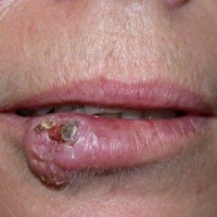  سرطان  سلول های سنگفرشی پوست (Squamous cell carcinoma)