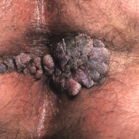 عکس زگیل مقعد