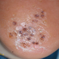 عکس زگیل پاشنه پا