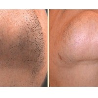 روش درمان موهای زائد دور لب و چانه چیست؟